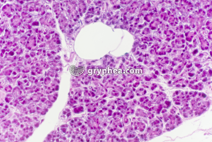 Pancréas pathologique Diabète de type 1 x100 - gryphea.org